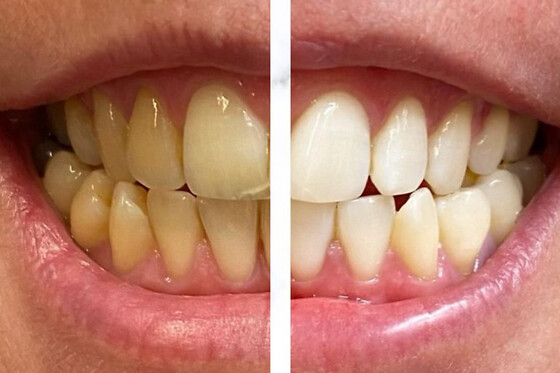 Bleaching and More - photo 8